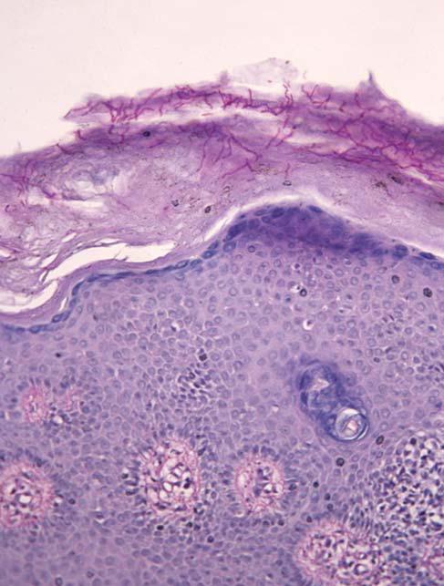 Рис. 3. Ветвящийся мицелий гриба в роговом слое эпидермиса (окраска ПАС-методом, х40).